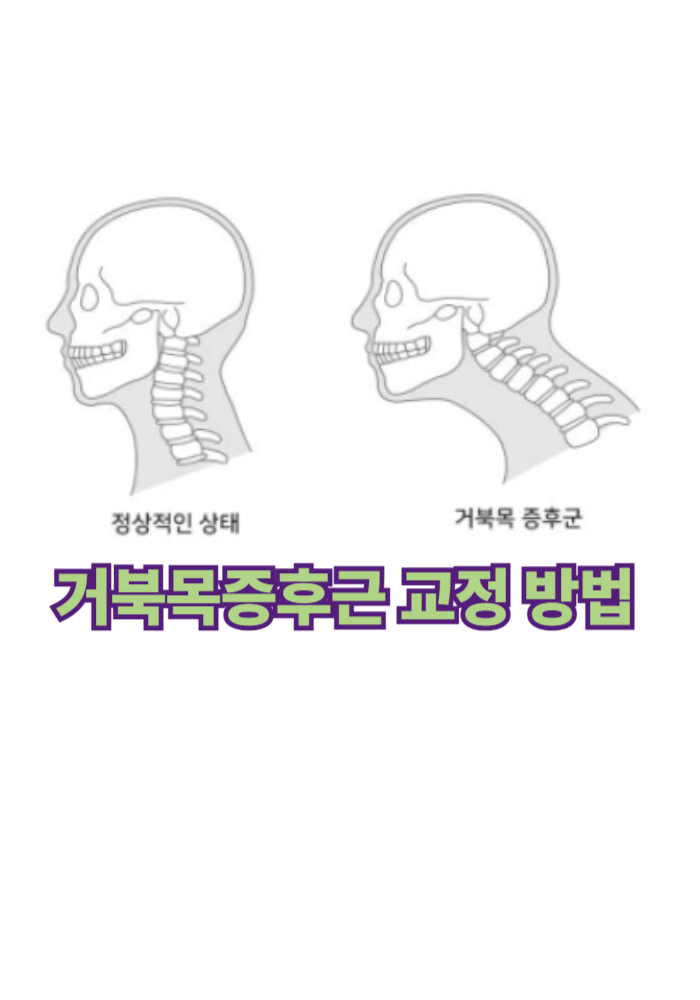 1.거북목증후근 교정 방법