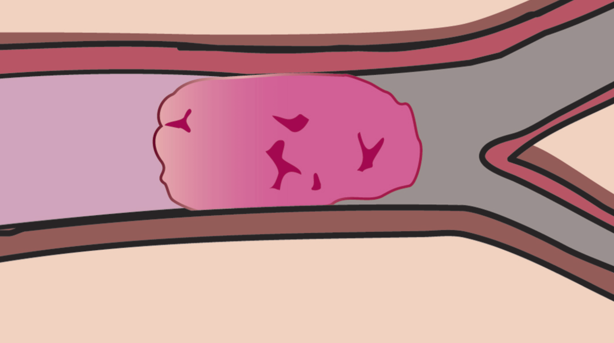 뇌혈관질환 원인