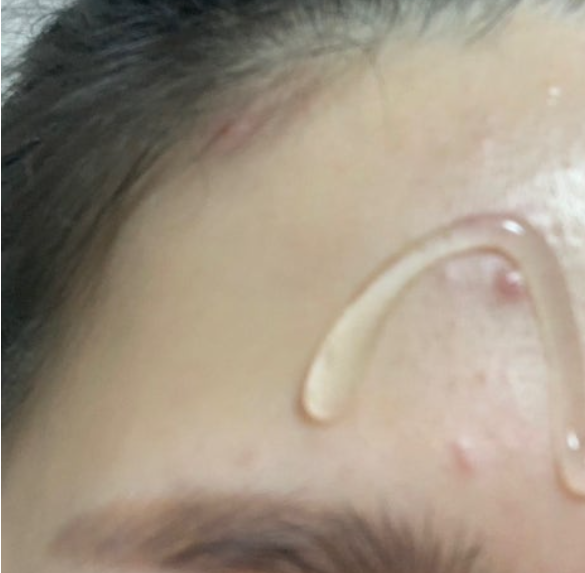 메디토 크림 내돈내산 효과