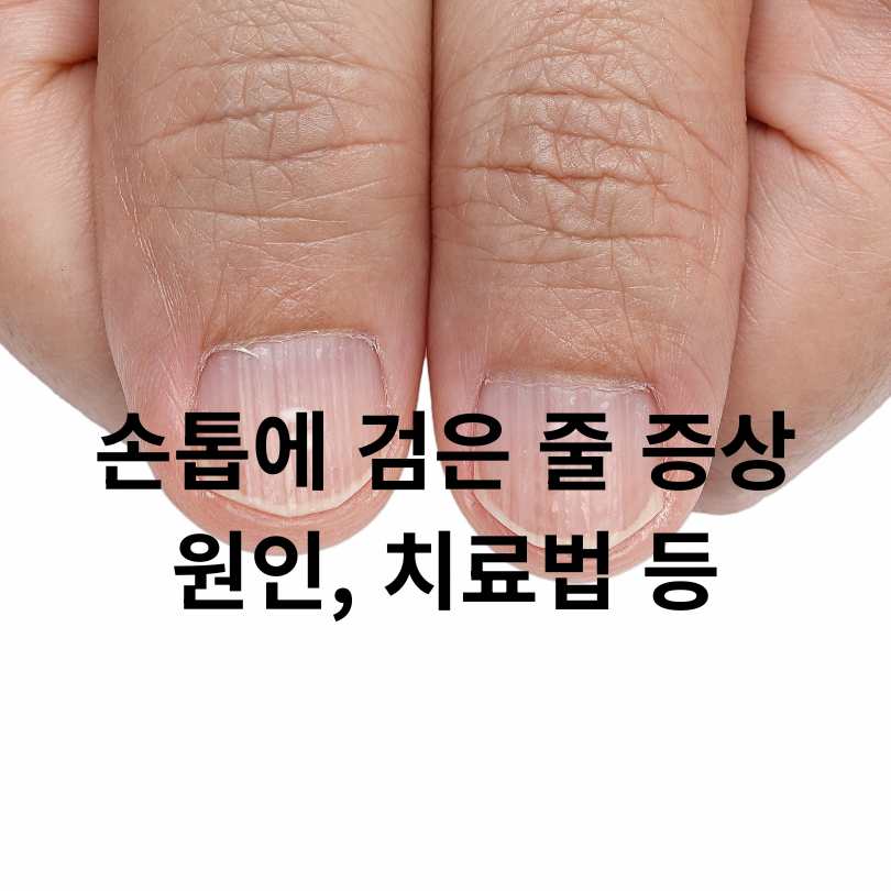 손톱에 검은 줄 증상,원인,치료법