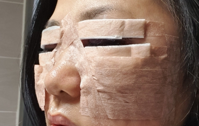 하안검 수술 후기