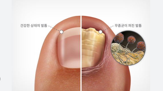 손발톱 무좀