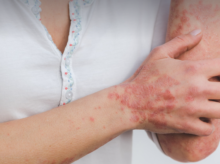 피부 건선 원인과 치료 관련 사진