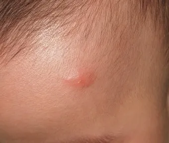 모기 물려 가려울 때 땀띠에 안티푸라민 연고 효능 부작용 사용후기_2