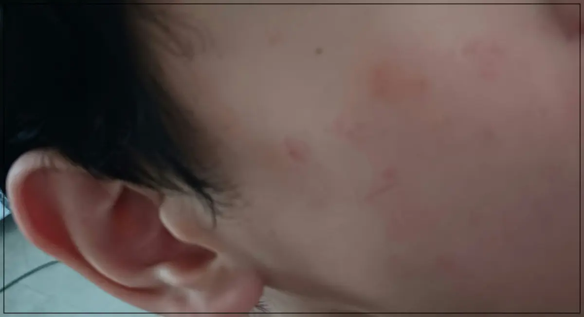 듀피젠트-주사기간이-돌아오면-얼굴에-발진이-올라오는-모습