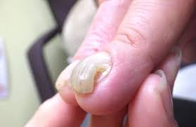 손톱이 두꺼워지는 현상과 질환 가능성