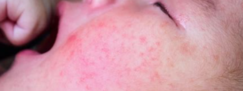 아토피 치료법1