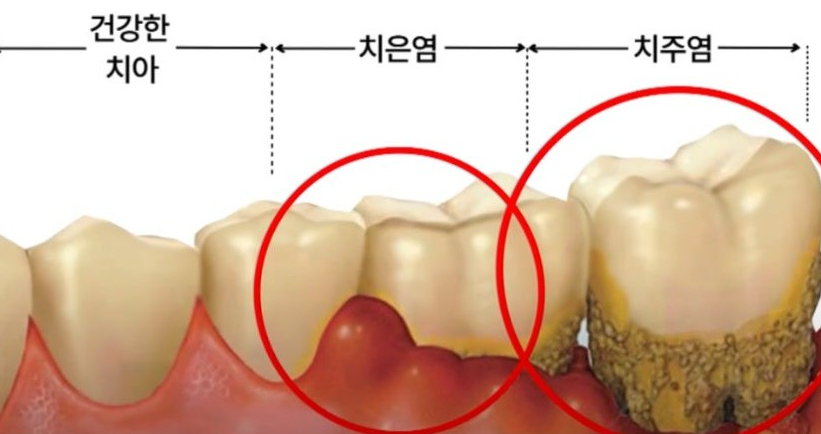구강 유해균 검사로 치주염 예방하기 관련 이미지
