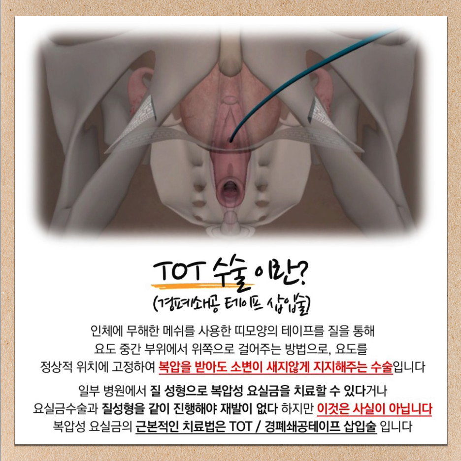 TOT수술, 요실금 수술방법