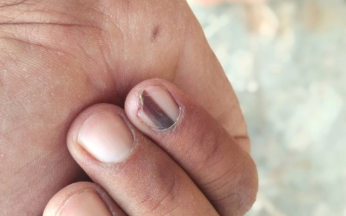 손발톱밑 흑색종 치료방법