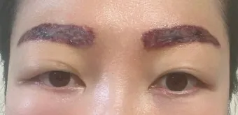 눈썹 문신 제거 방법 꿀팁_13