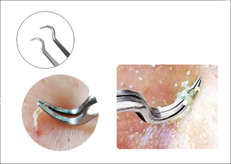 피지 압출기 사용법