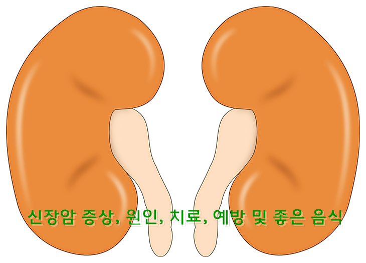 신장암 증상, 원인, 치료, 예방 및 좋은 음식