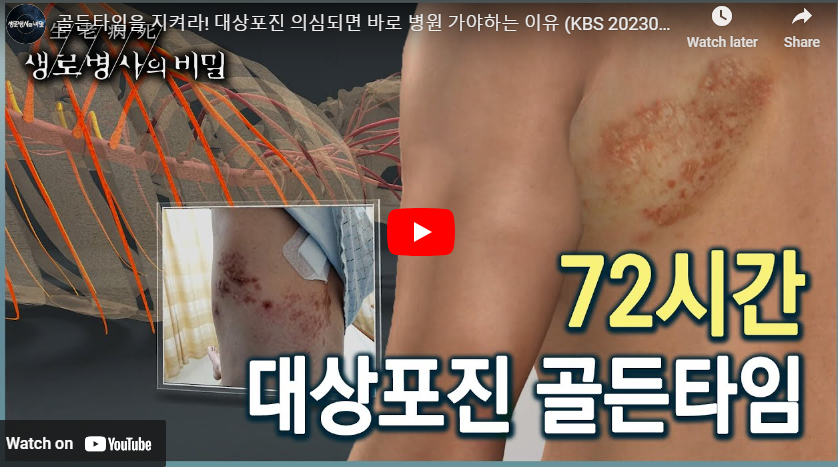 대상포진주사가격 비교 대상포진 초기증상 전염