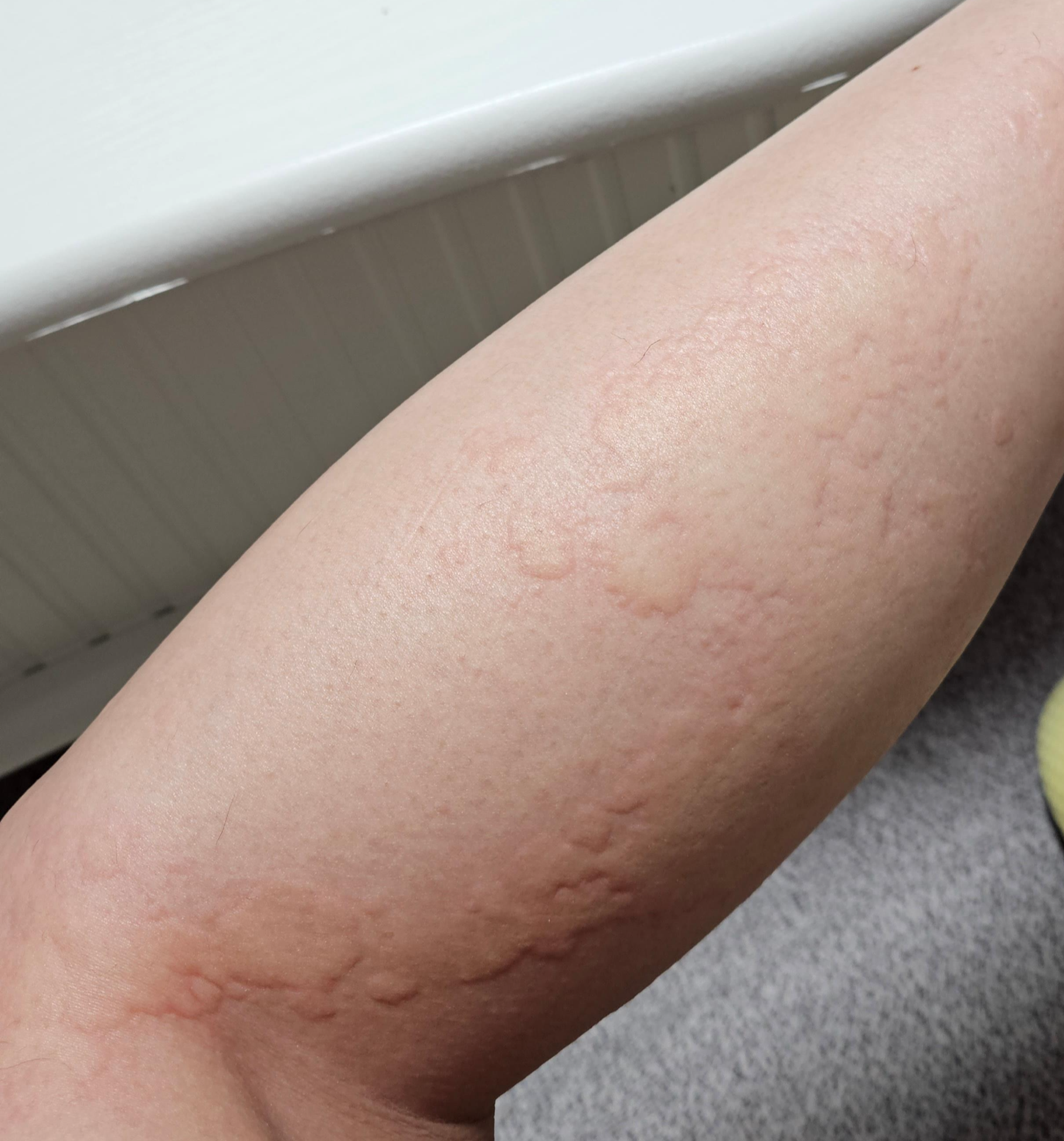 콜린성 두드러기 관련 사진