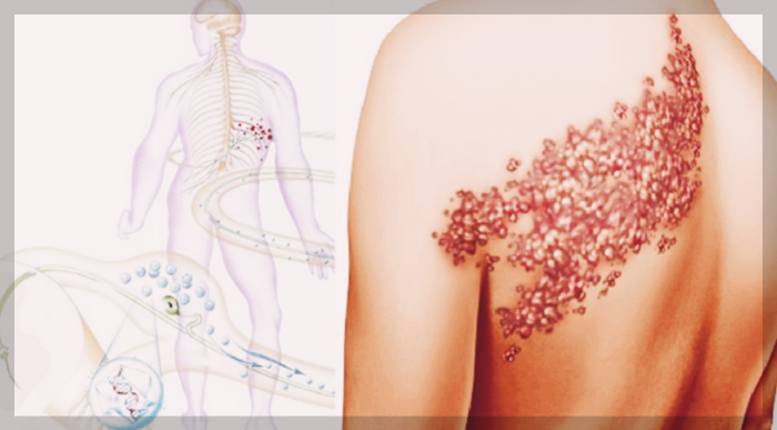 대상포진증상-사진1