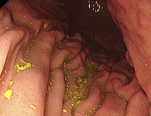 담즙 역류성위염2_출처:EndoToday