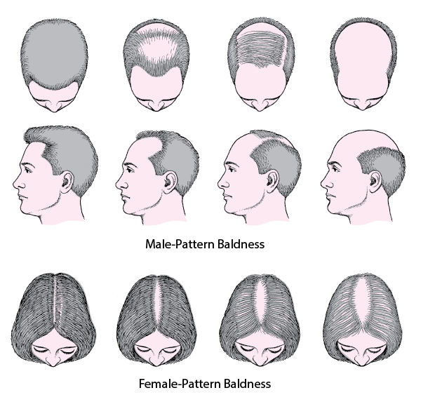 간헐적 단식 : 탈모
