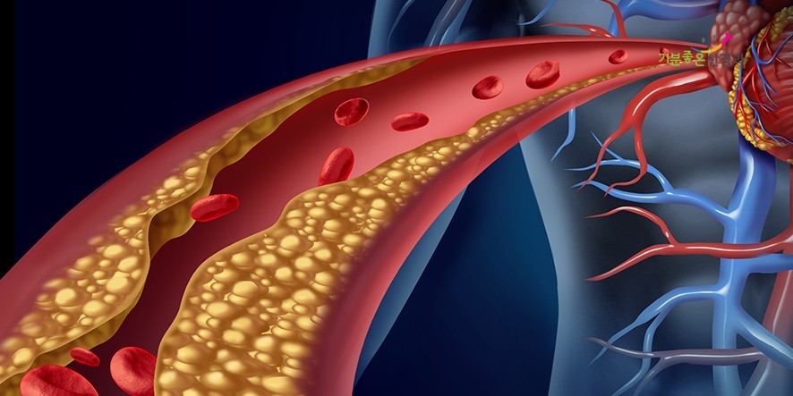 죽상동맥경화증