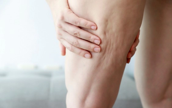 셀룰라이트란 정확한 뜻과 사진 및 셀룰라이트 없애는 법 5가지 총정리