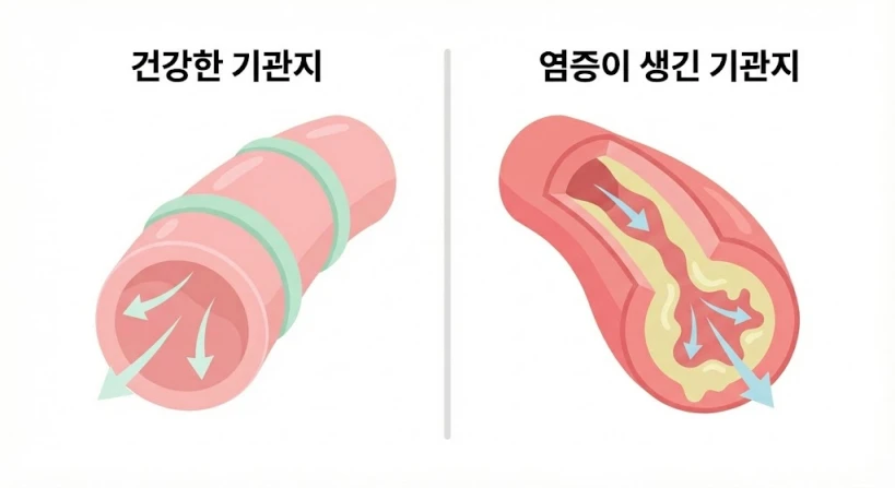화면이 반으로 나뉘어 왼쪽에는 깨끗하고 분홍빛을 띠는 건강한 기관지 단면이, 오른쪽에는 염증으로 붓고 노란 가래가 껴있는 좁아진 기관지 단면이 그려진 일러스트입니다. 복잡하지 않은 플랫 디자인으로 두 상태의 차이를 명확하고 깔끔하게 비교하고 있습니다.