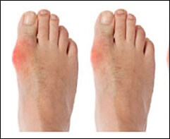 요산수치 낮추는 음식 2