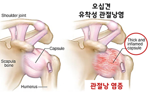 어깨가 아파요