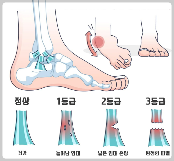 발목염좌 3단계