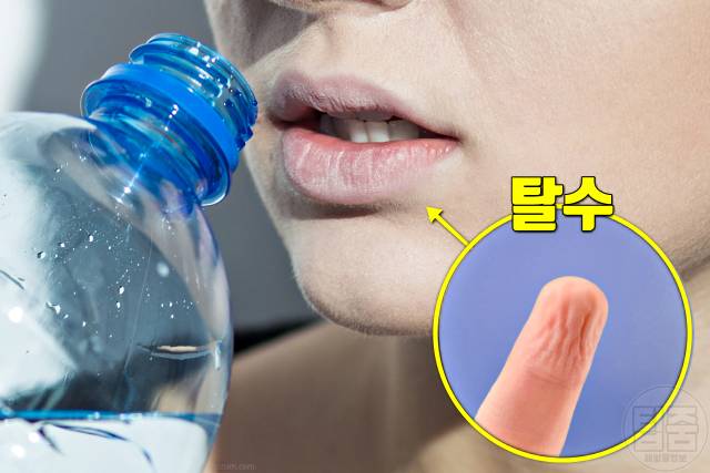 손가락 주름 병 질환 탈수증