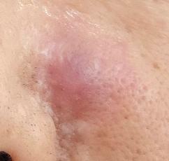 오른쪽 코 옆, 모낭염으로 염증이 심하다.