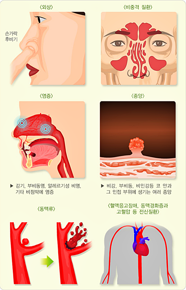 코피가 나는 이유_국가건강정보포털