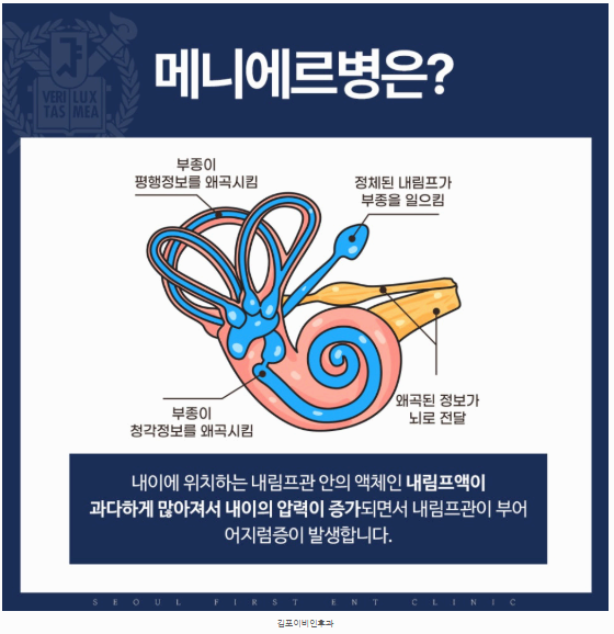 메니에르병이란? 증상·원인·치료·예방까지 총정리
