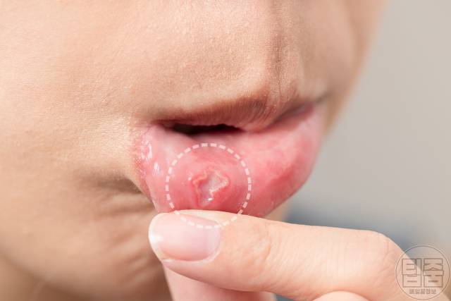 토마토효능 토마토 매일 먹으면 구강암