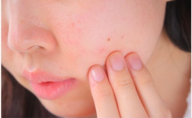 피부암과 점의 차이