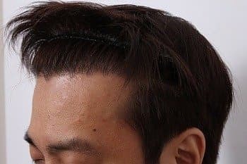 모발이식 후기