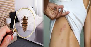 빈대 물린자국 : 빈대 퇴치법&amp;#44; 증상&amp;#44; 예방법