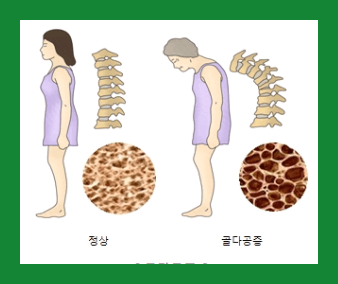 골다공증예방