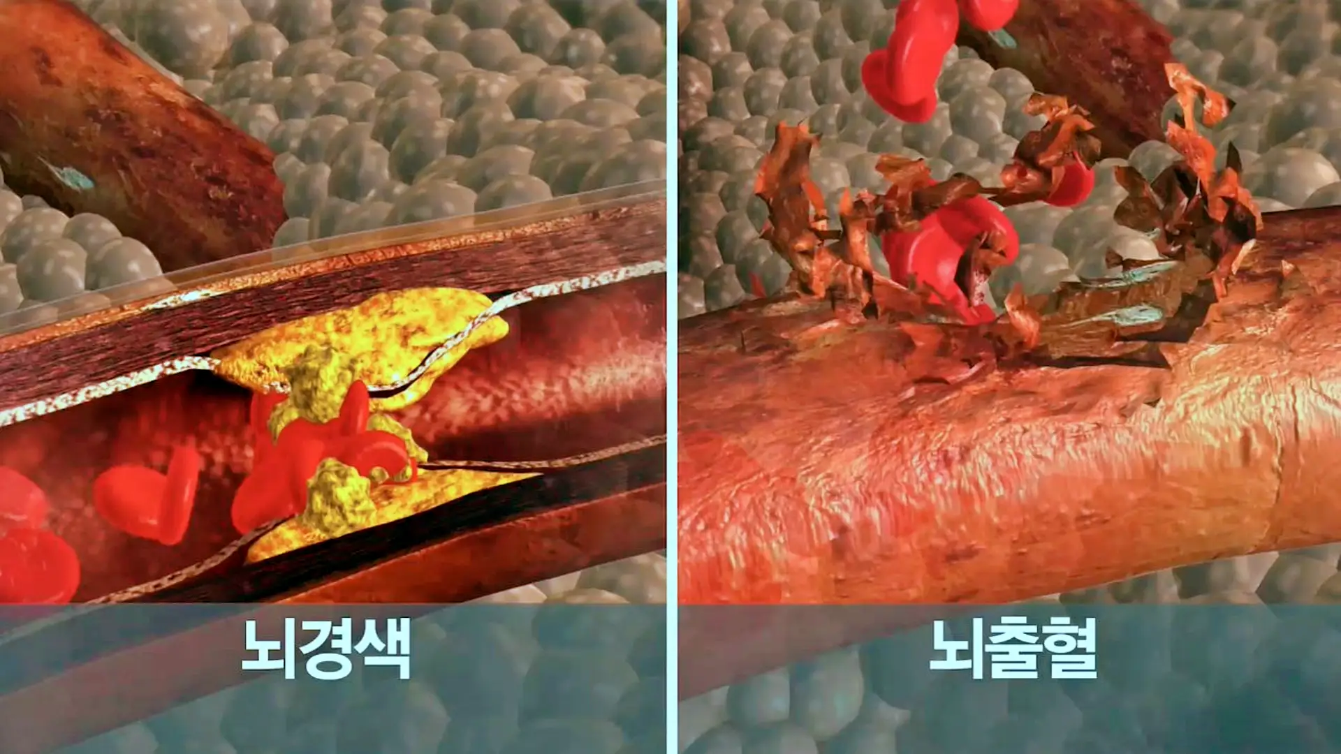 KBS 생로병사의 비밀 835회 뇌졸중 치료, 후유증, 뇌동맥류 검사 예방법 방법 오늘방송 다시보기 정보