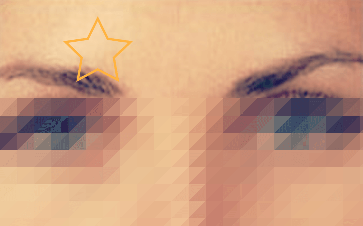 미간-보톡스-시술-후-매끈해진-미간의-모습