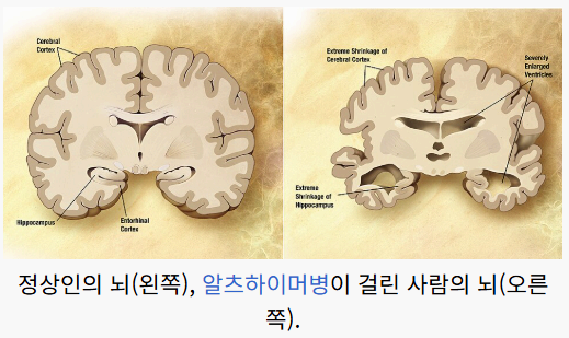 알츠하이머병(치매) 이미지사진