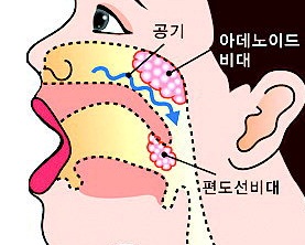 Enlarged Adenoids