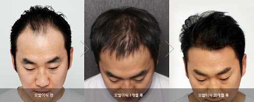모발이식-성공사례