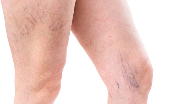 하지정맥류 베나실 치료법 및 장단점