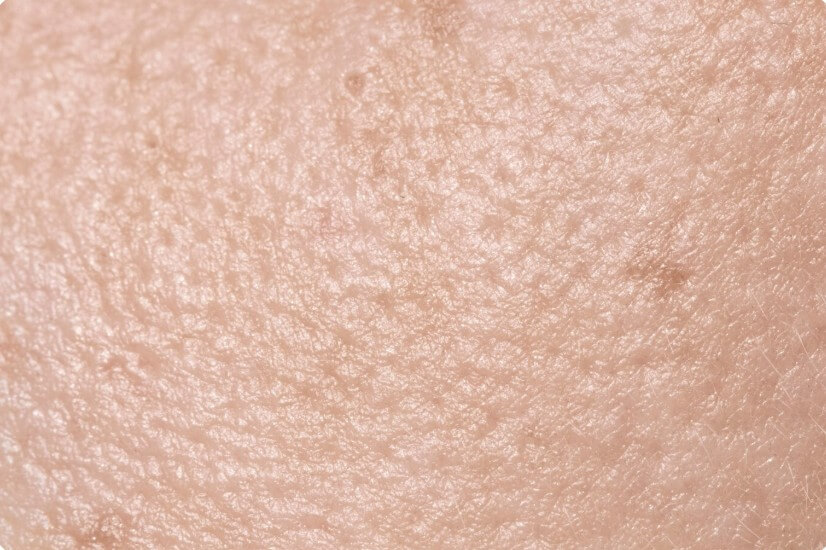 모공각화증 피부 증상