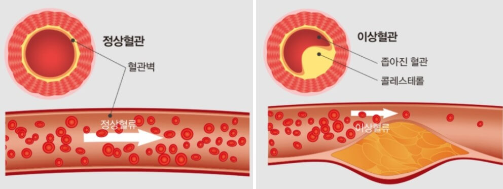 혈관 속 노폐물의 정도