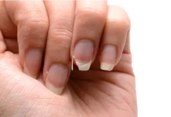 비오틴 효능 및 부작용, 비오틴 결핍 증상