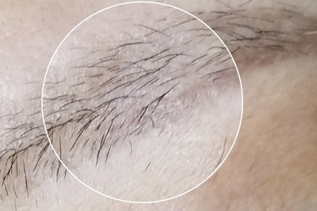 서울 눈썹문신 제거후 관리 제거비용 눈썹문신 제거 후기