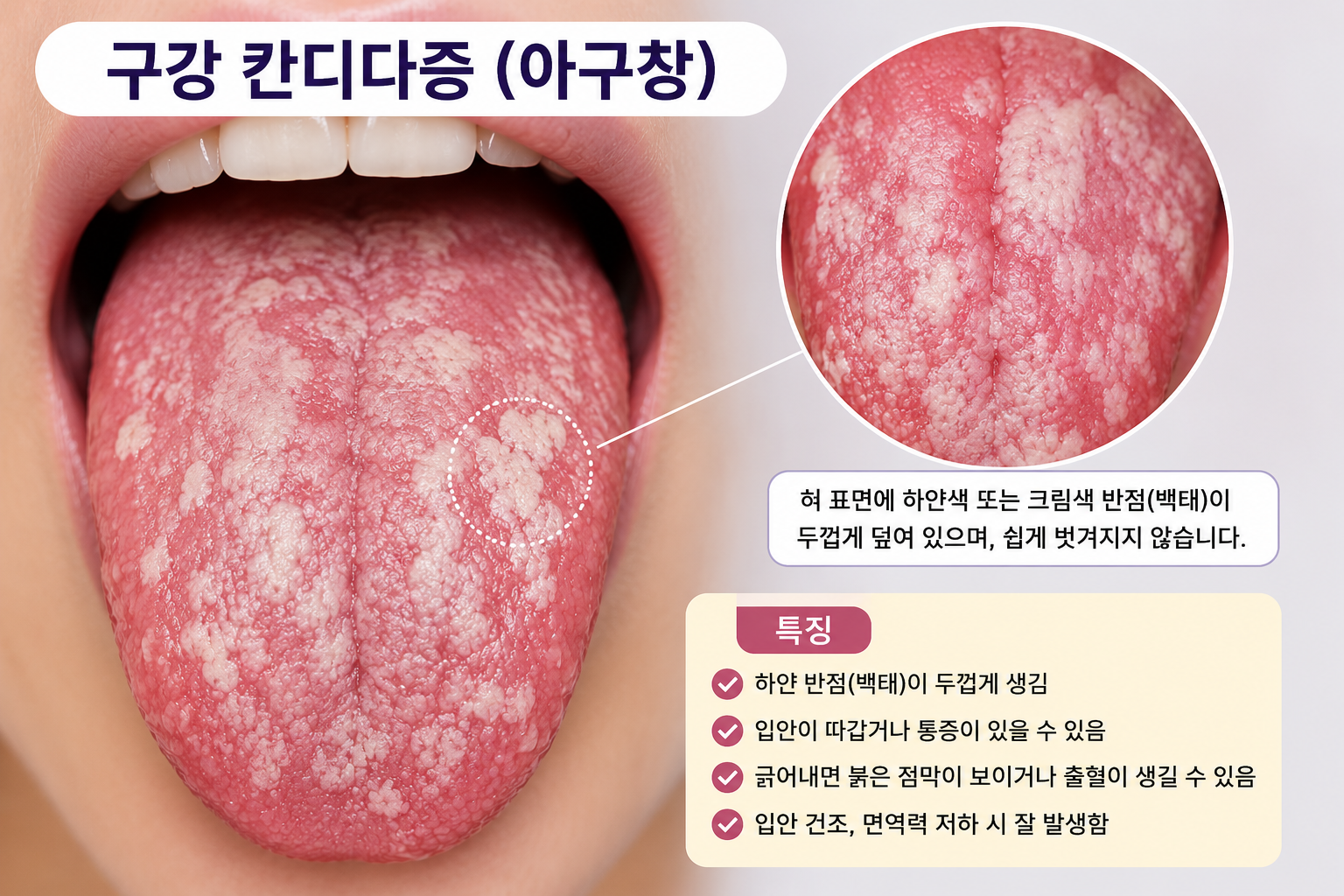 구강 칸다다증