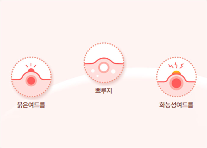 애크논 크림, 효과, 가격, 사용법