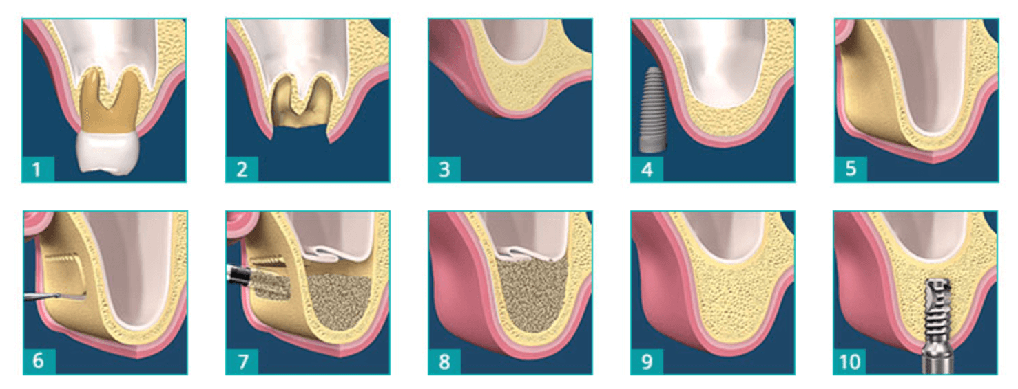 상악동거상술 순서